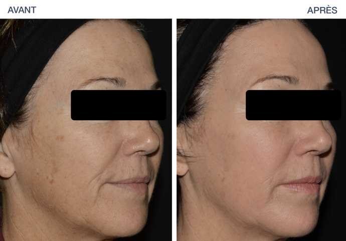 Skin Resurfacing — before and after