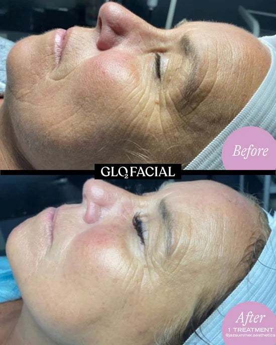 חידוש עור — before and after