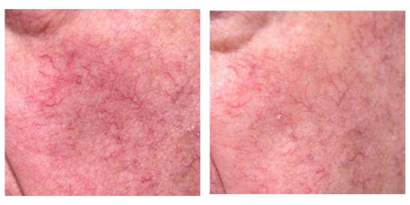 נגעים וסקולריים ואדמומיות בפנים — before and after