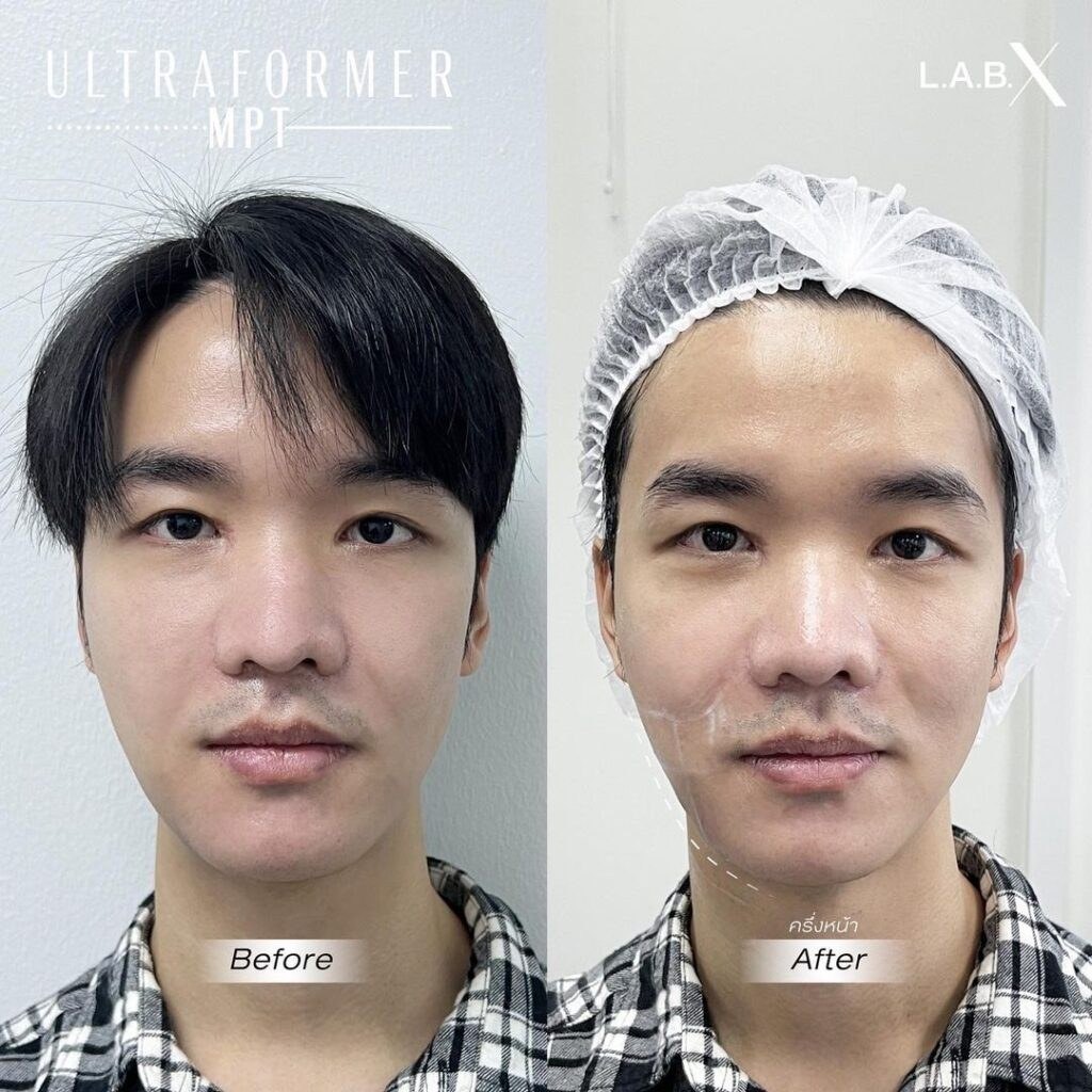 מיצוק עור — before and after