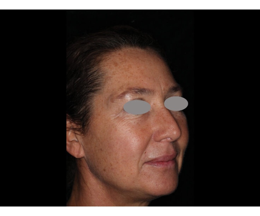 הצערת עור — before