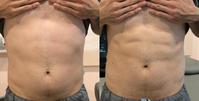 עיצוב גוף — before and after
