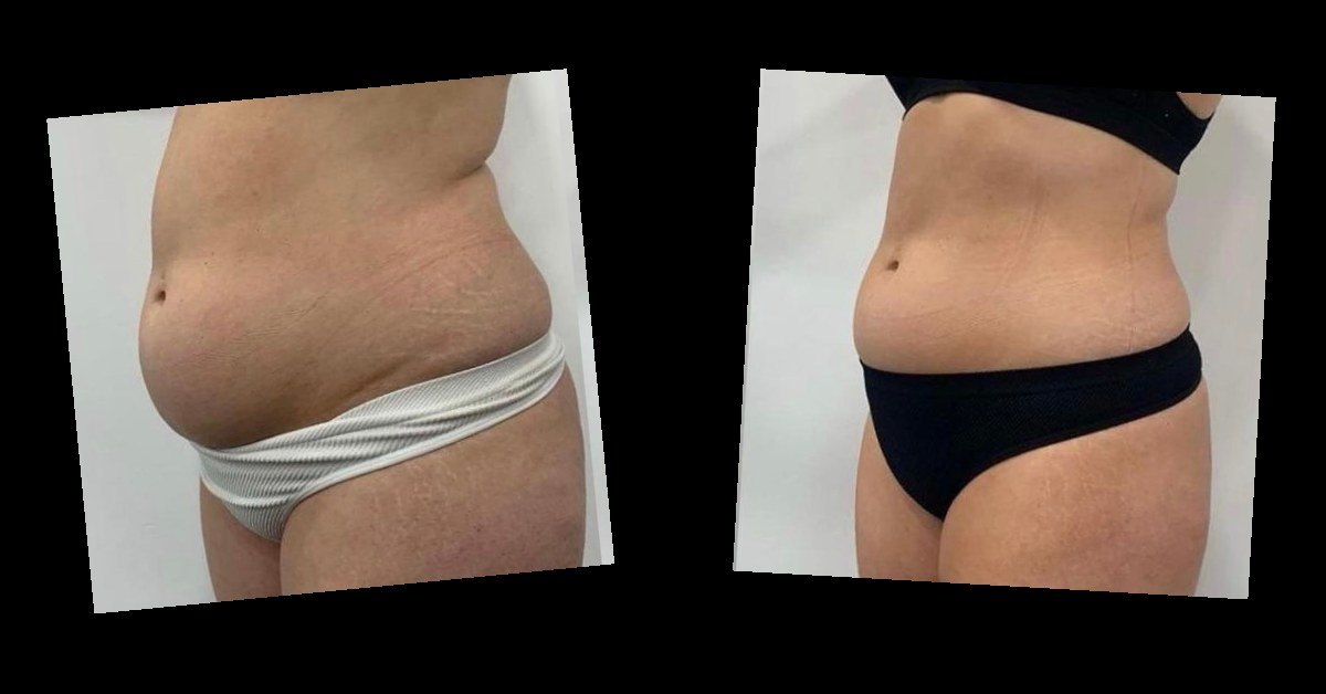 Body Contouring — before and after