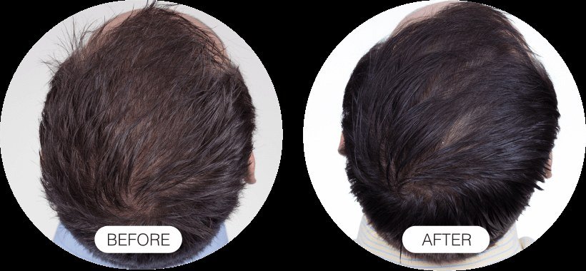 Hair Growth — before and after