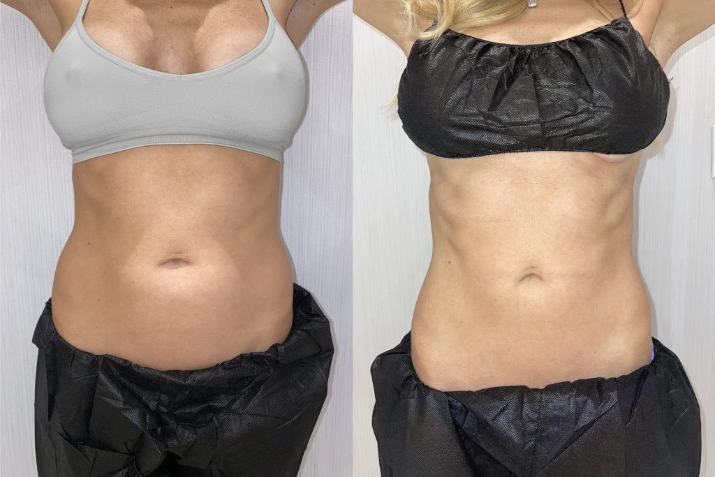 עיצוב גוף — before and after