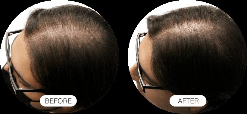 Hair Growth — before and after