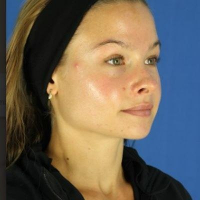 Acne & Scars — after