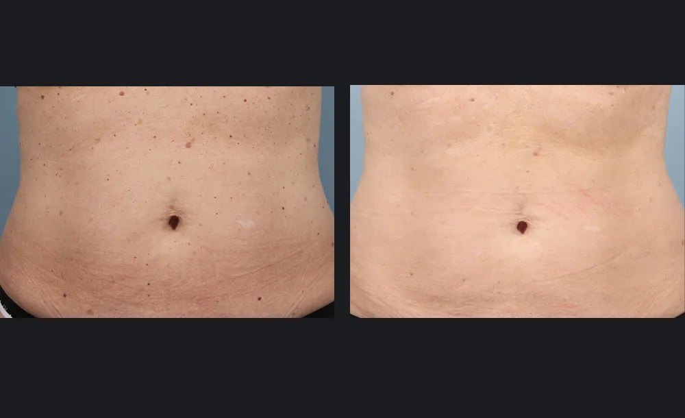 פטרת ציפורניים — before and after