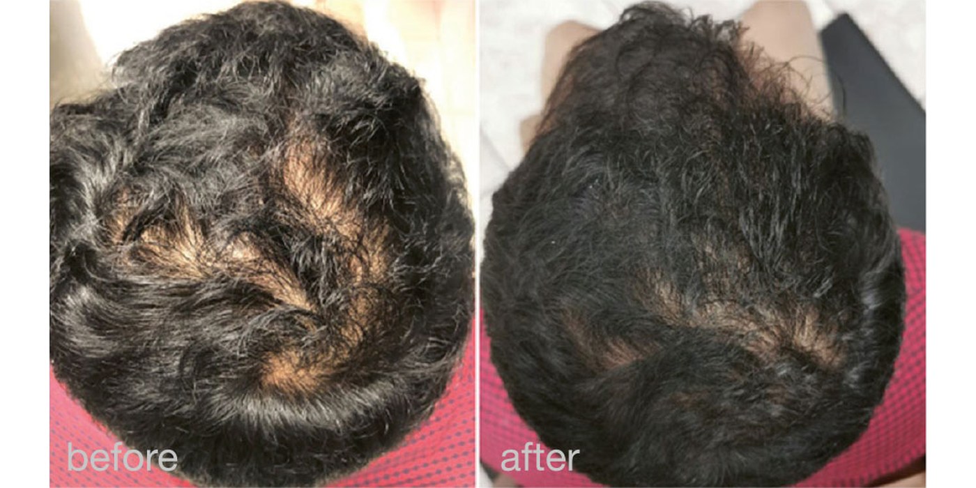 Hair Growth — before and after