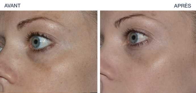 Skin Resurfacing — before and after