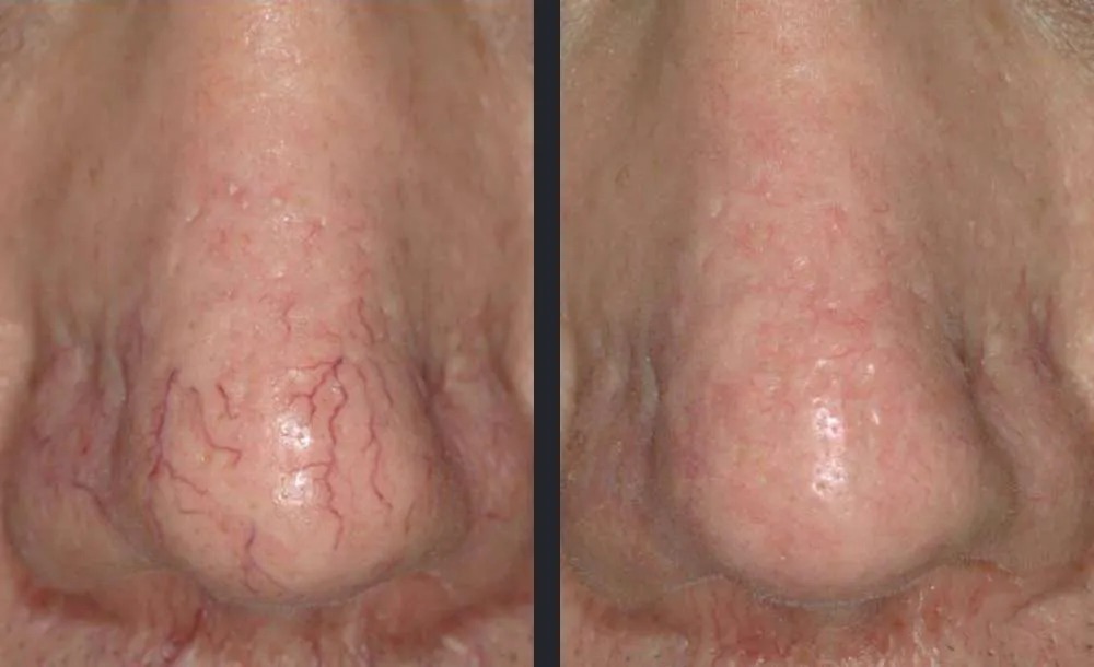 נגעים וסקולריים — before and after