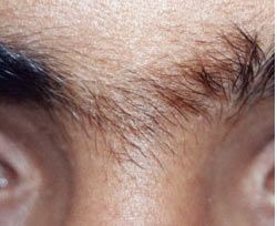 הפחתת שיער בגבות — before