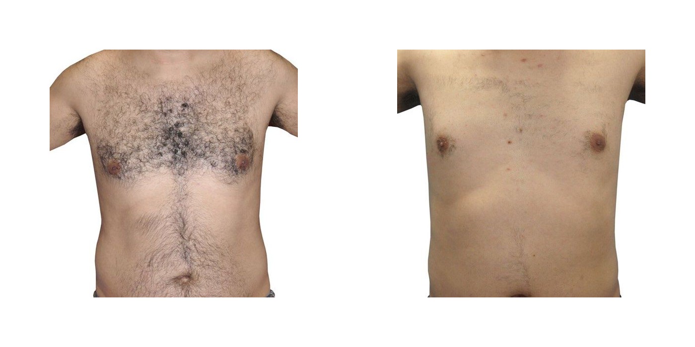 הסרת שיער — חזה ובטן — before and after