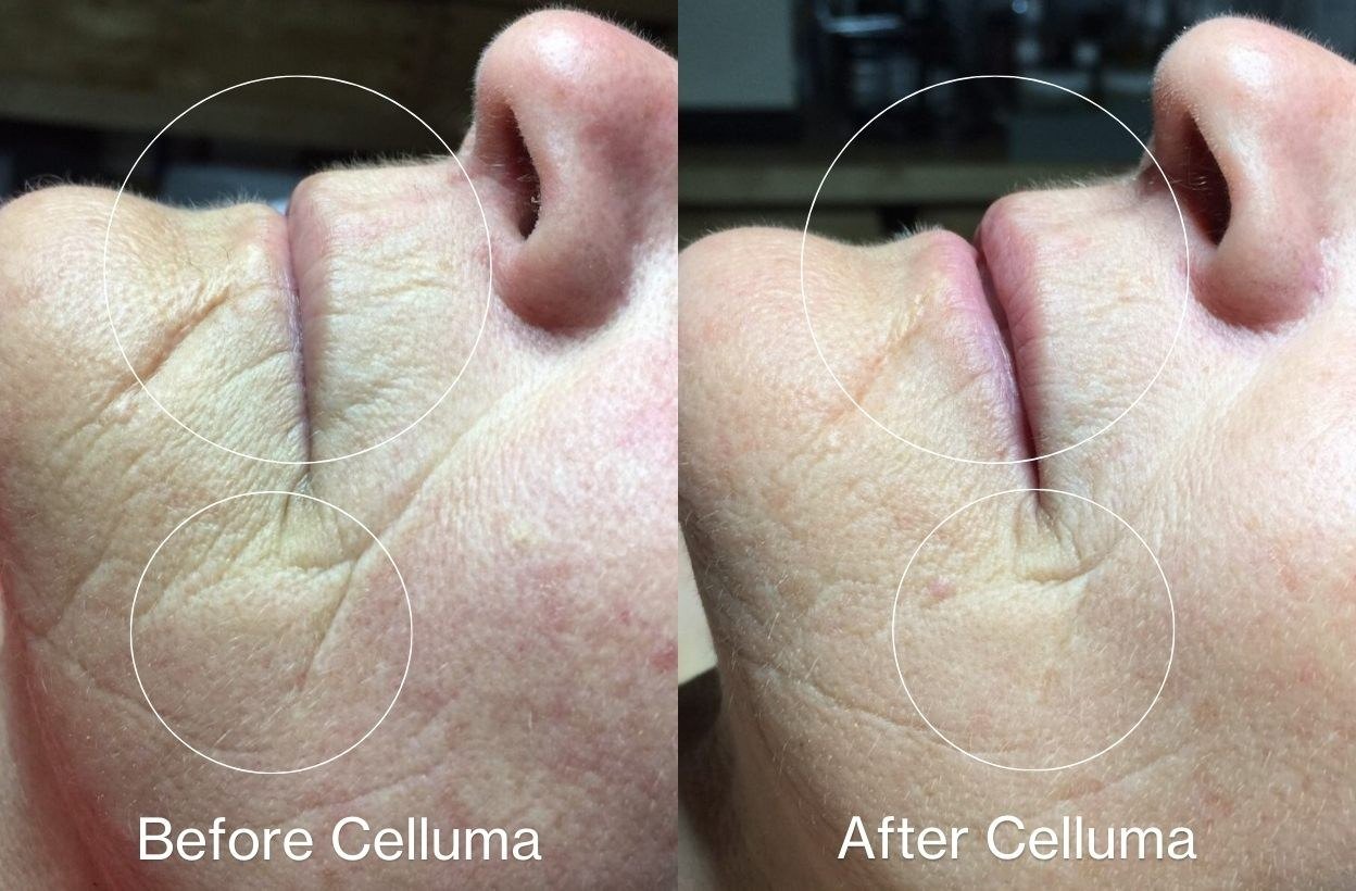 חידוש עור — before and after