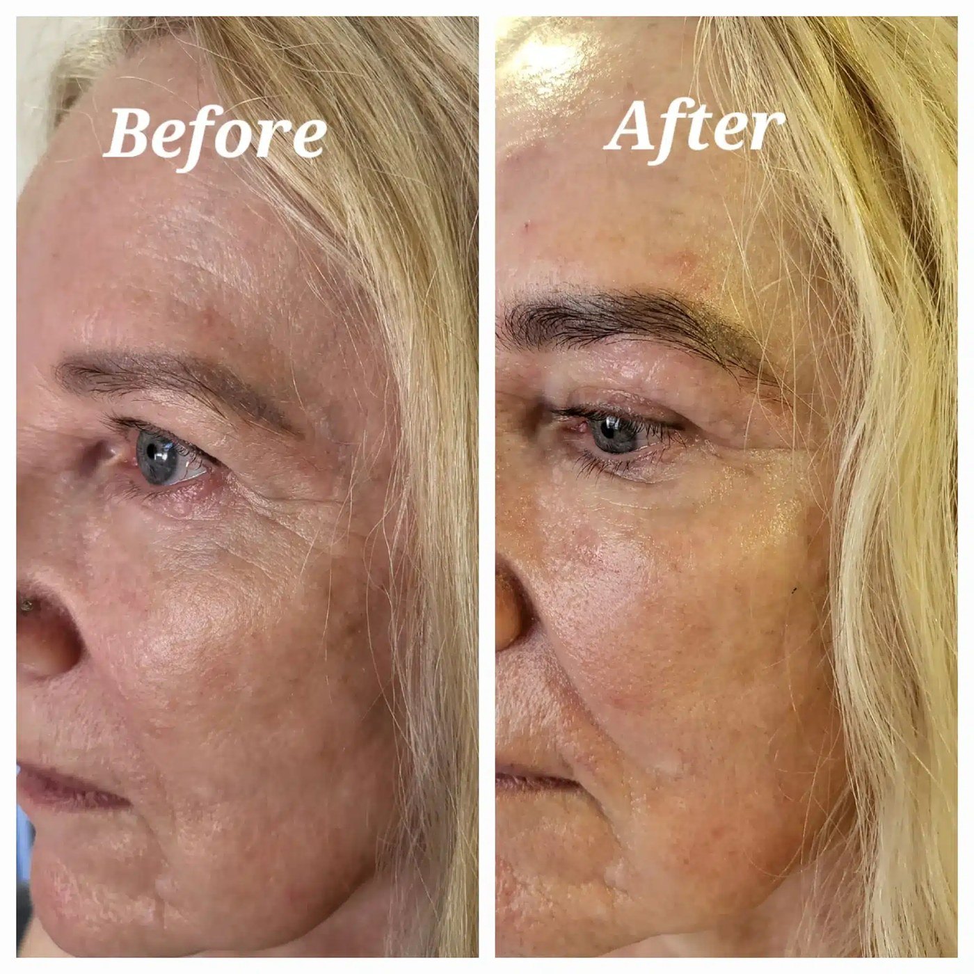 חידוש עור — before and after