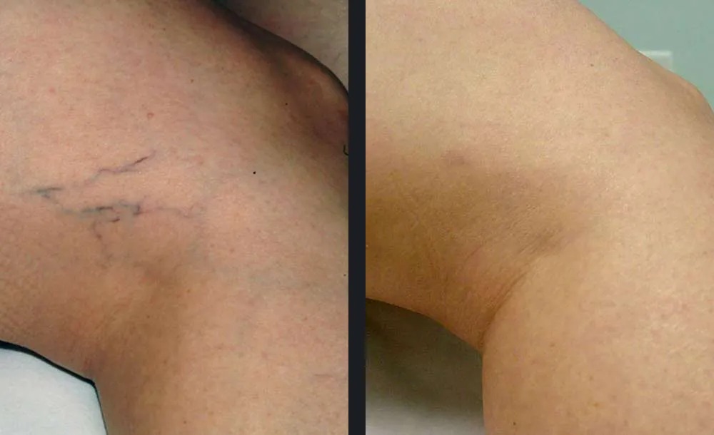 נגעים וסקולריים — before and after