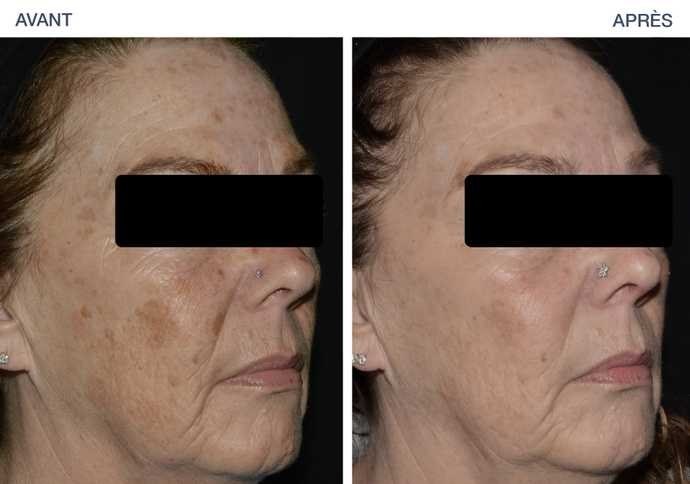 Skin Resurfacing — before and after