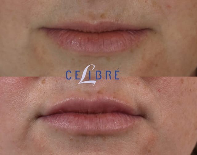 חידוש עור — before and after