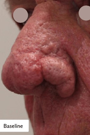 ריניופימה — before
