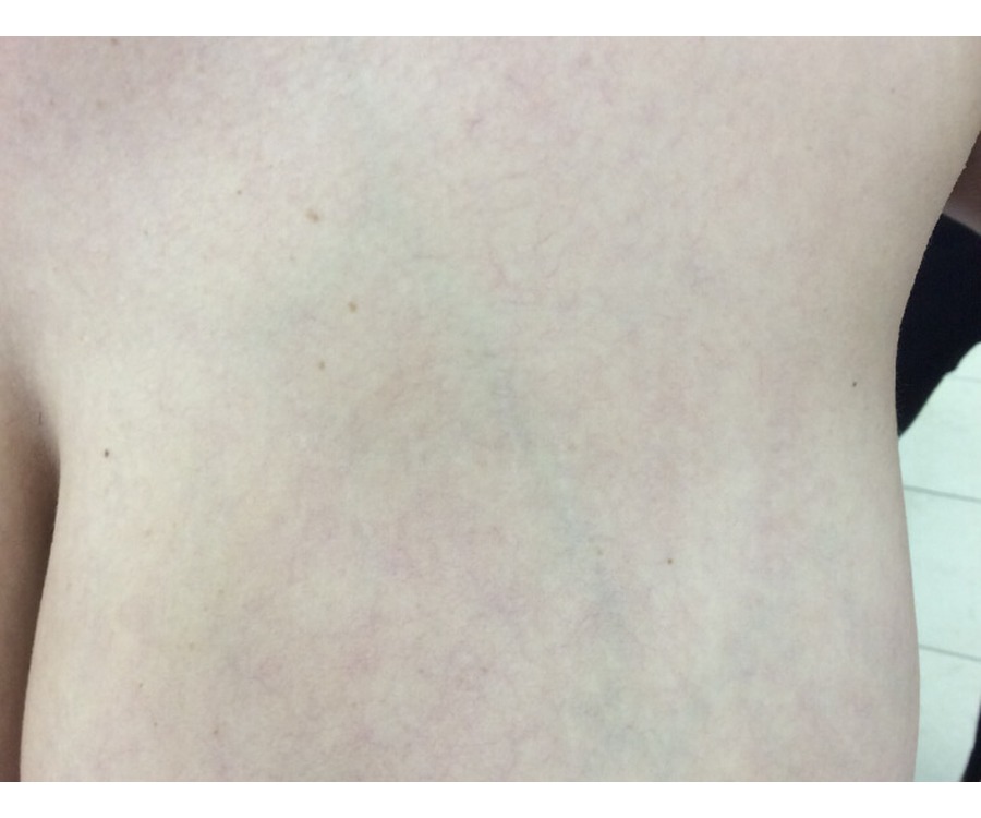 סימני מתיחה — after