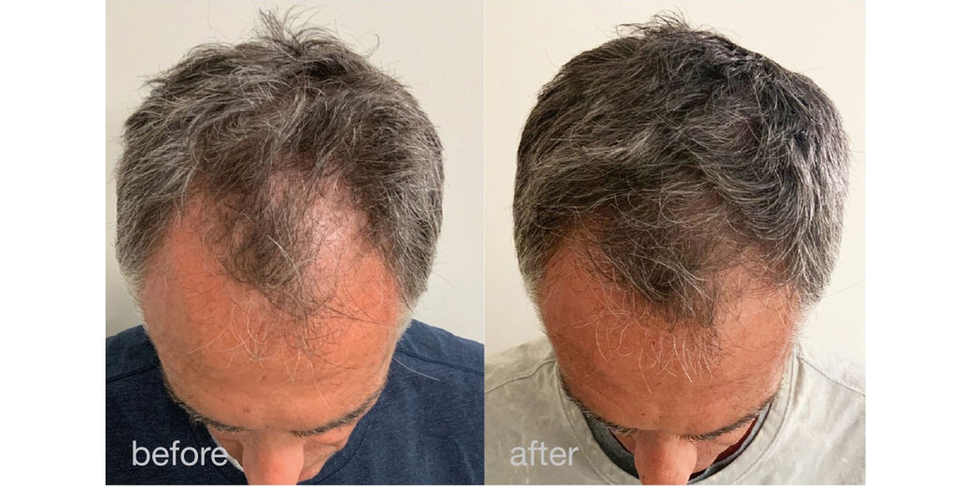 Hair Growth — before and after