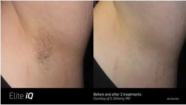 הסרת שיער — before and after