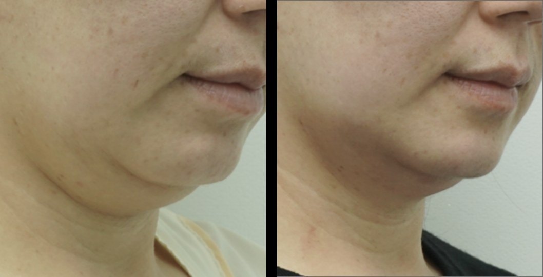 עיצוב גוף — before and after