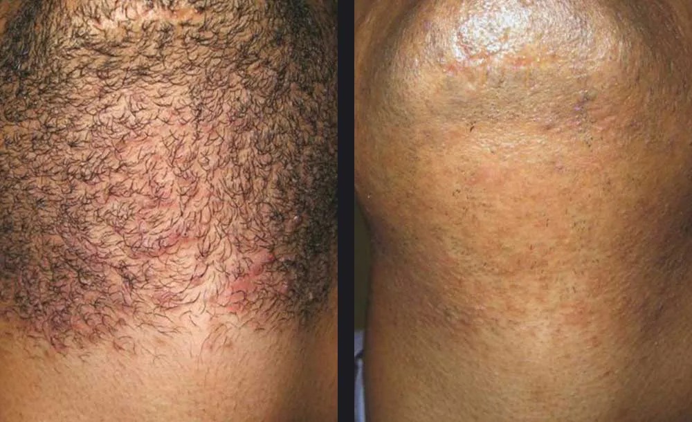 הסרת שיער — before and after