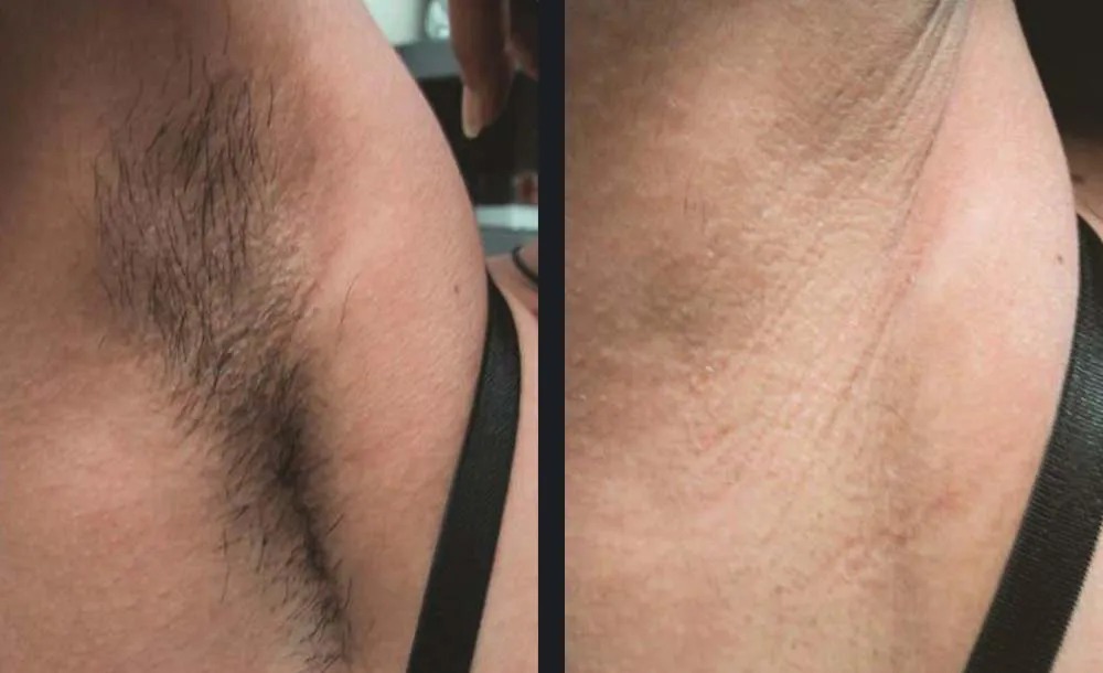 הסרת שיער — before and after