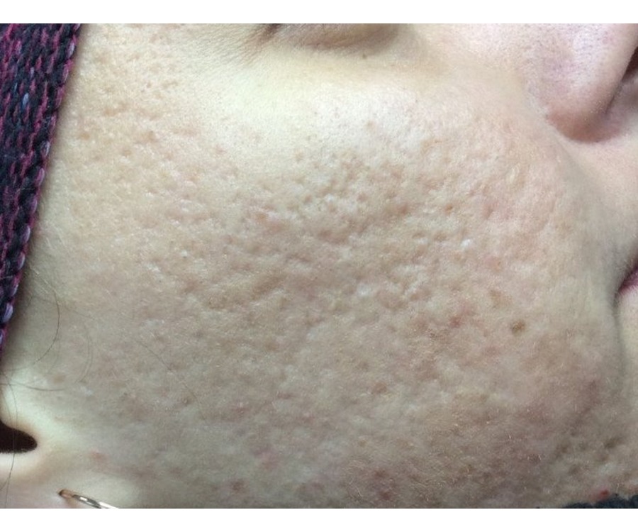 צלקות אקנה — before