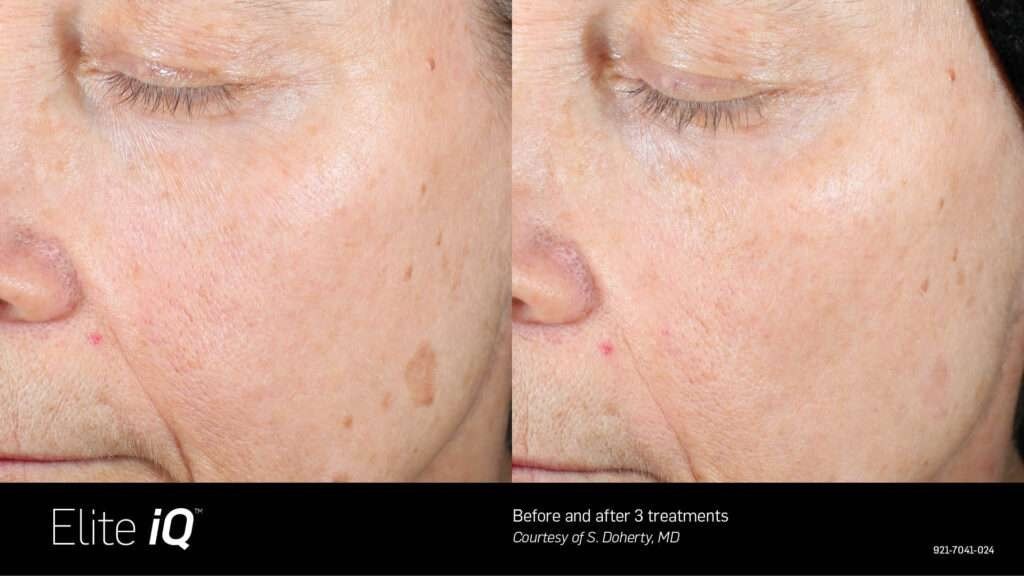 הסרת שיער — before and after