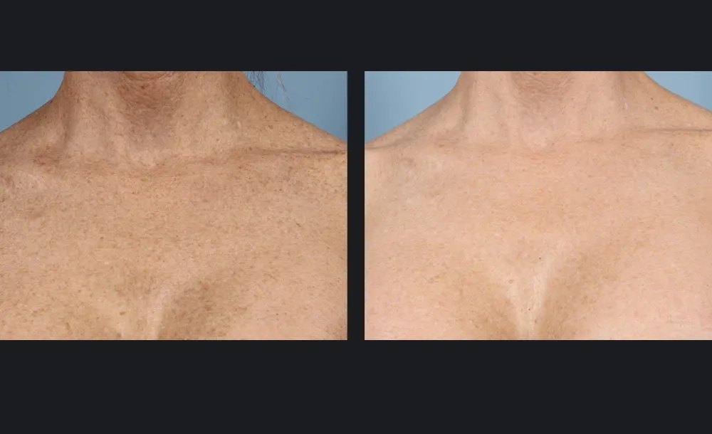 נגעים וסקולריים — before and after