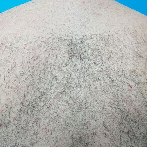 הסרת שיער — before