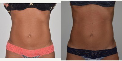 חיטוב שרירים — before and after
