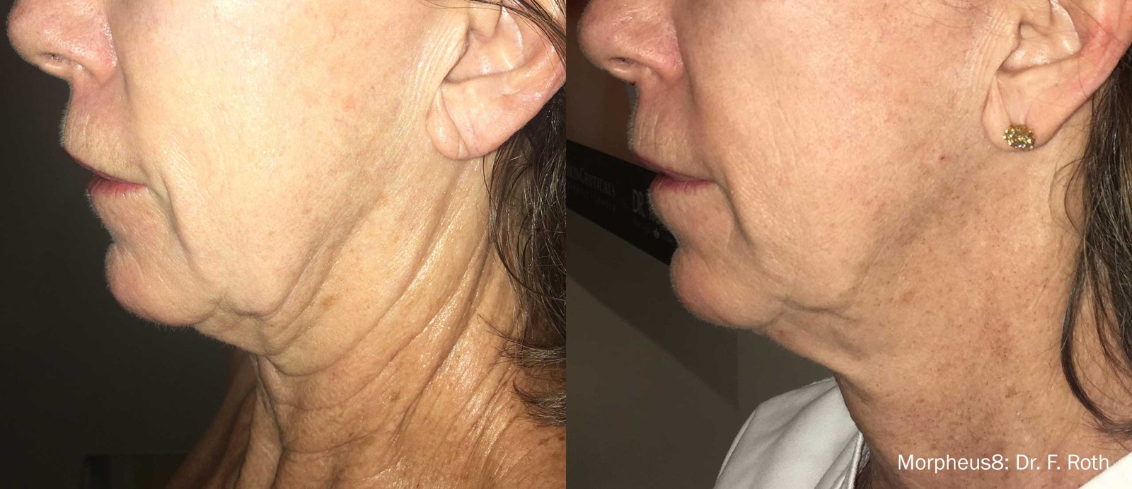 מרקם עור הפנים וחידוש עור — before and after