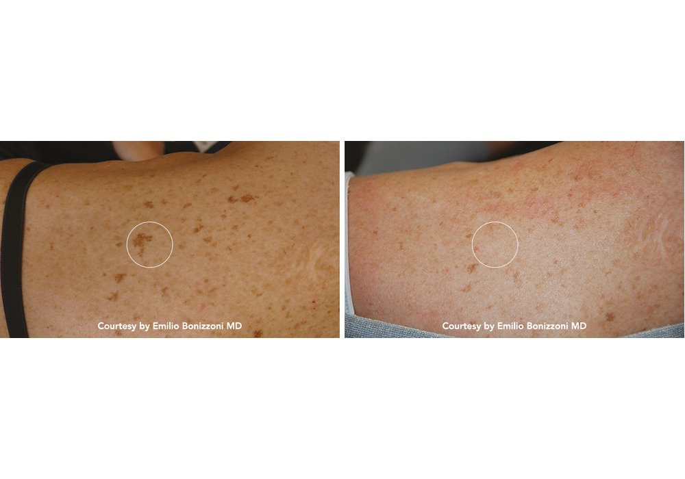 נגעים פיגמנטריים שפירים — before and after