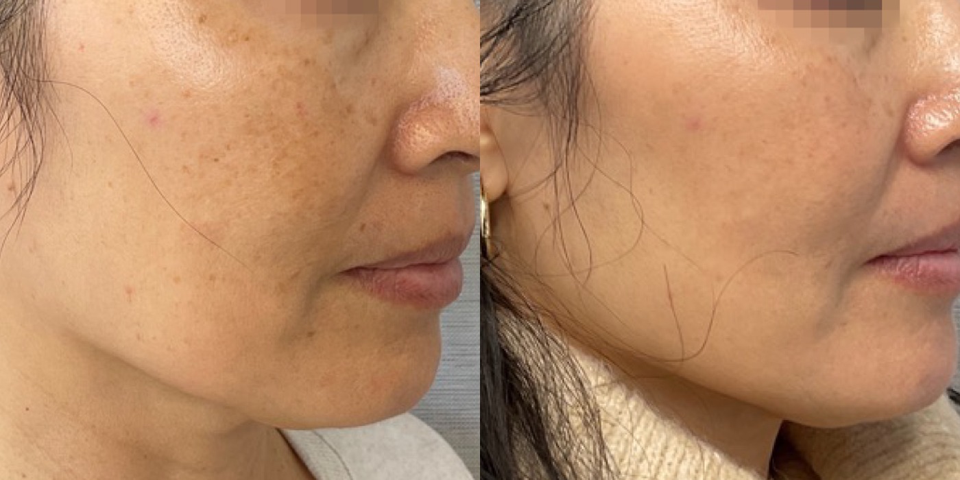 Pigmentation & skin revitalization — before and after