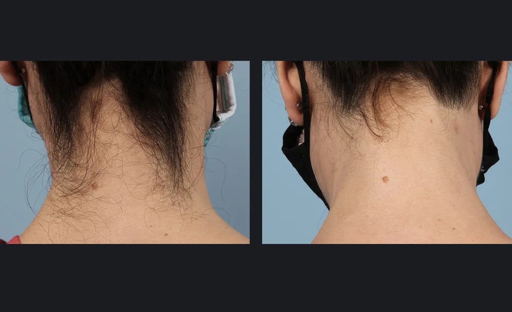 הסרת שיער — before and after