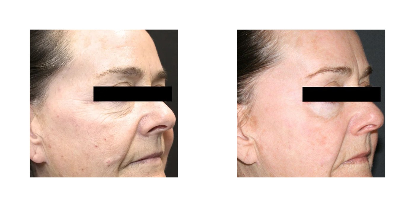 TriBella — חידוש פנים מלא — before and after