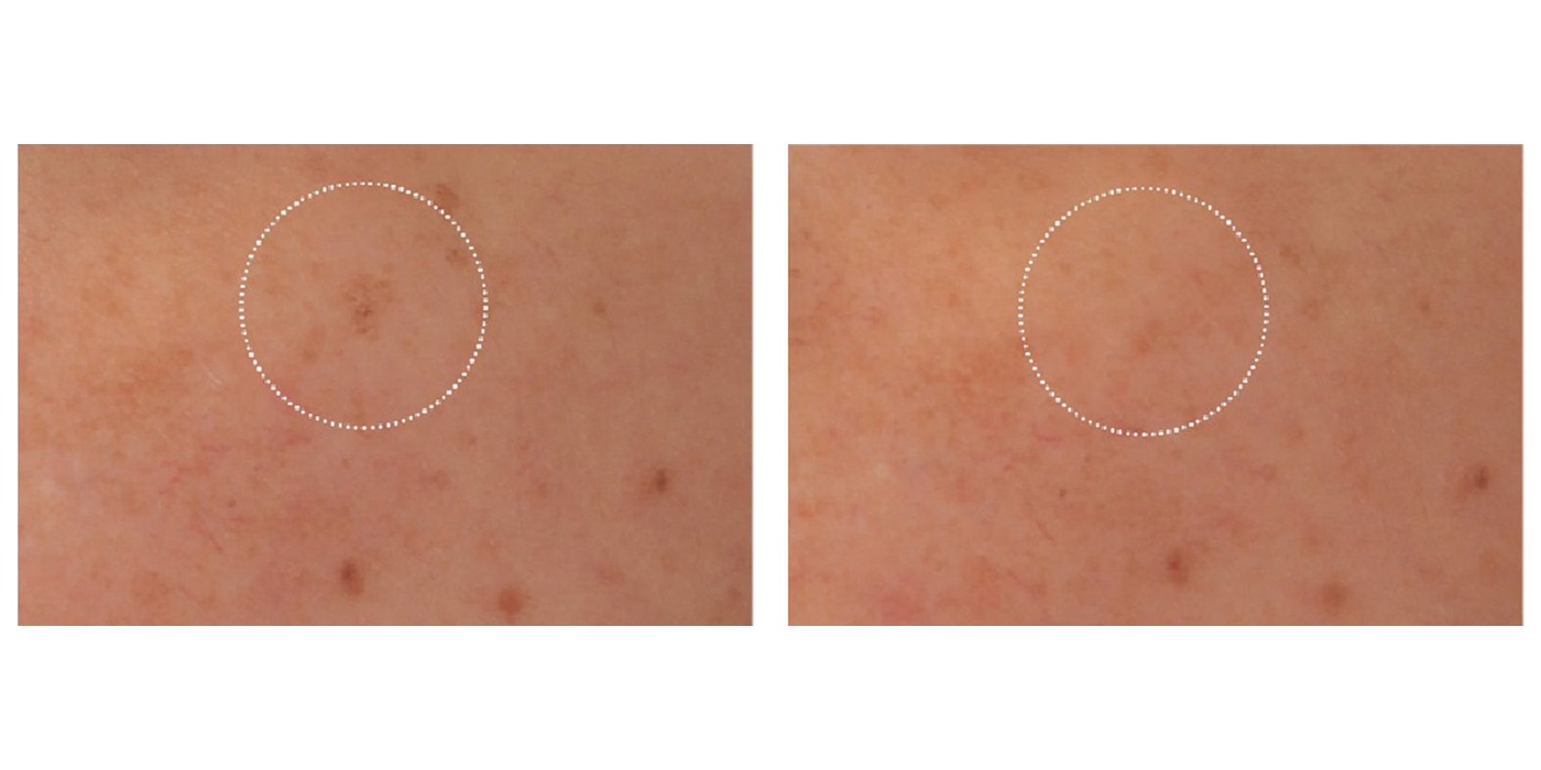 נגעים פיגמנטריים — before and after