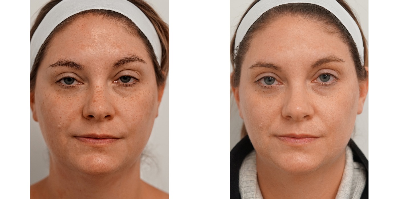 BBL HEROic — פיגמנטציה וגוון עור בפנים — before and after