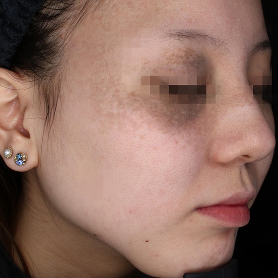 פיגמנטציה — before