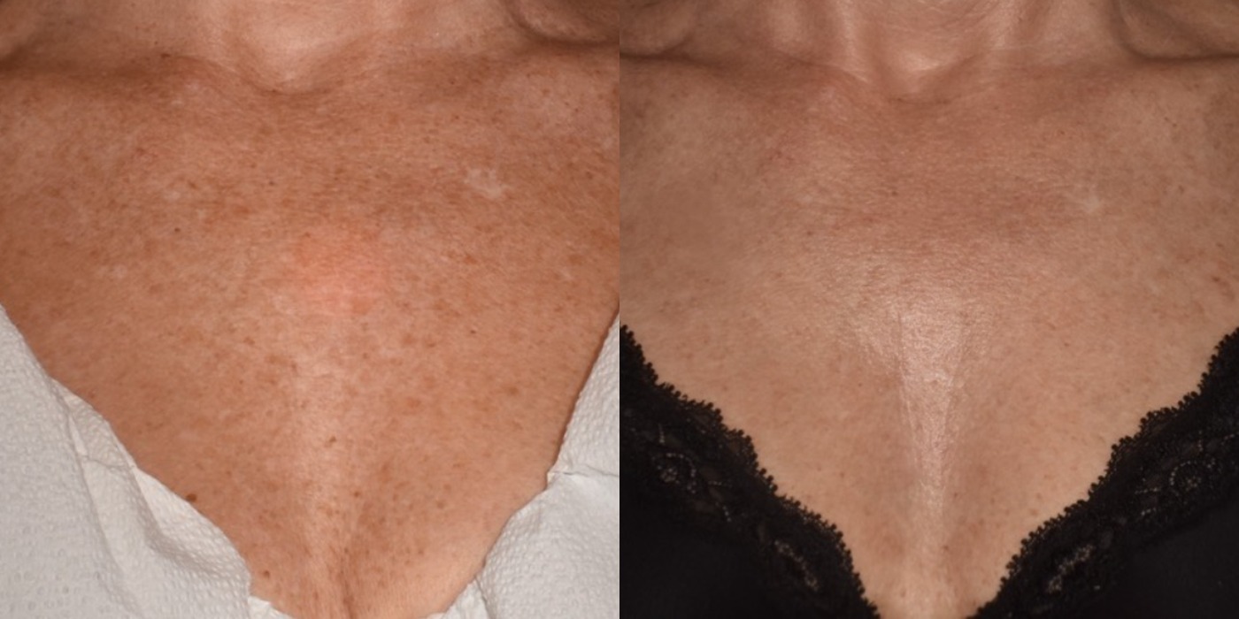 Skin resurfacing — before and after