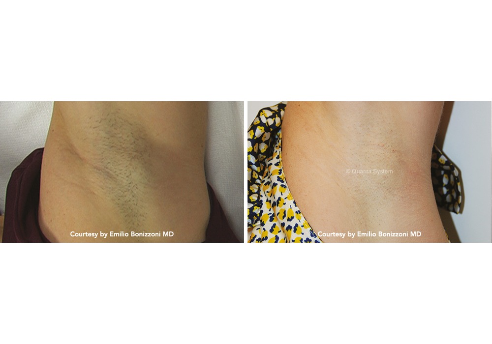 הסרת שיער קבועה — before and after
