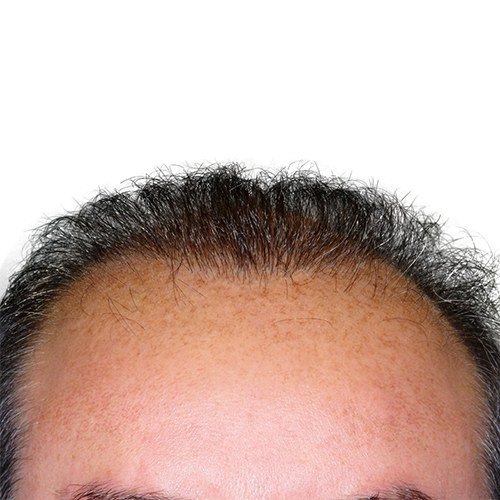 צמיחת שיער — after