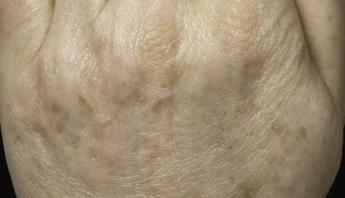 קרטוזיס אקטינית — after