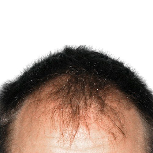 צמיחת שיער — before