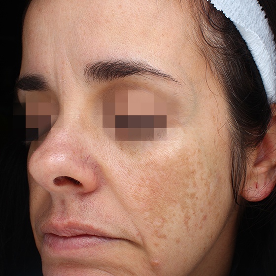 פיגמנטציה — before