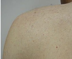 הפחתת שיער בכתפיים — after