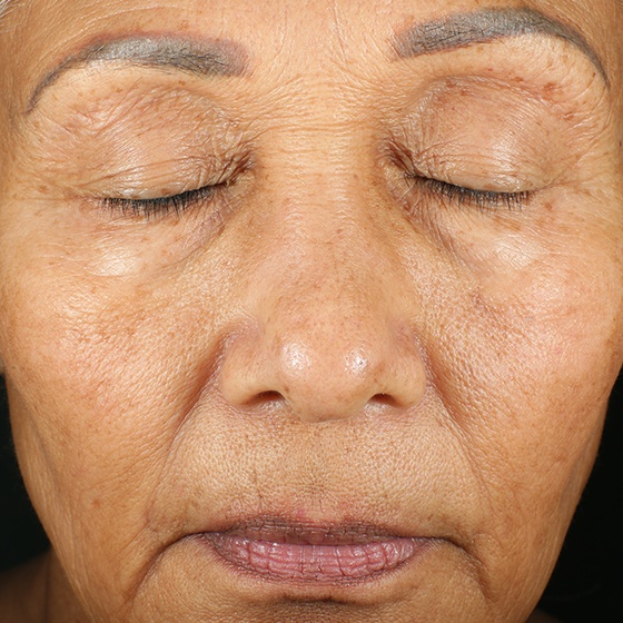פיגמנטציה — after